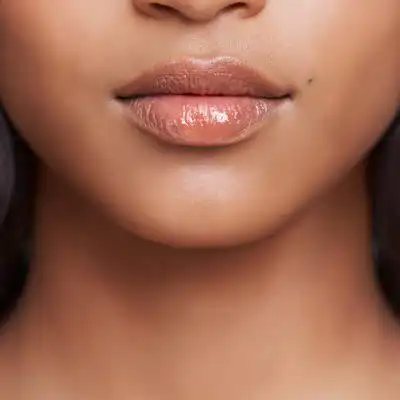 Juvéderm® and Teosyal® Dermal Fillers
