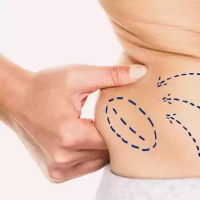 Non-Surgical Fat Reduction Treatment Near Me